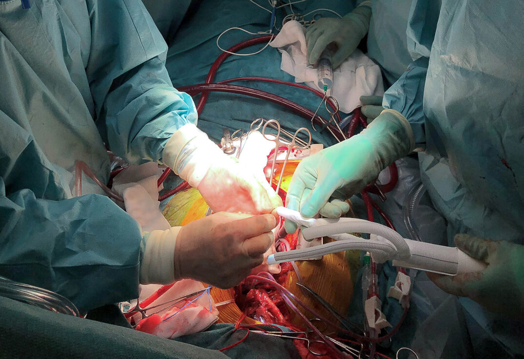 aorta operasjon fremhevet