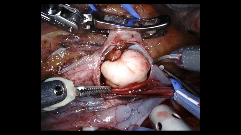 Foto av organer og robotverktøy, fra operasjon