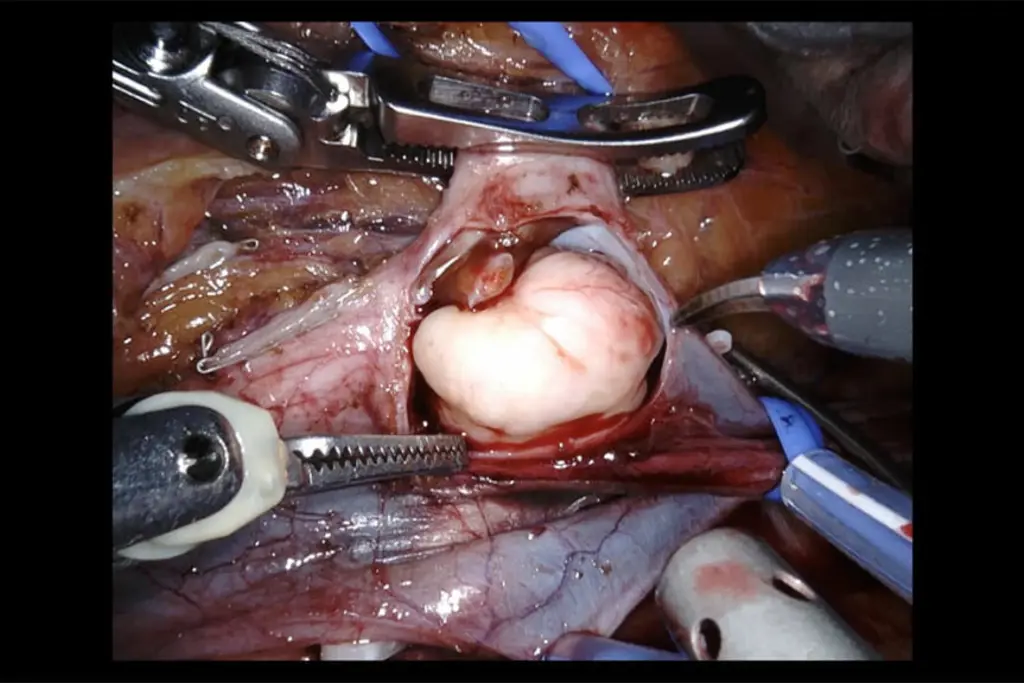 Foto av organer og robotverktøy, fra operasjon