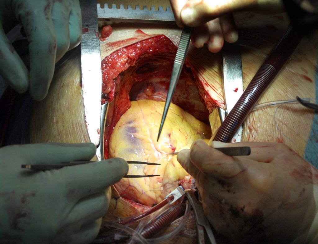 En person som holder en kniv over en hummer