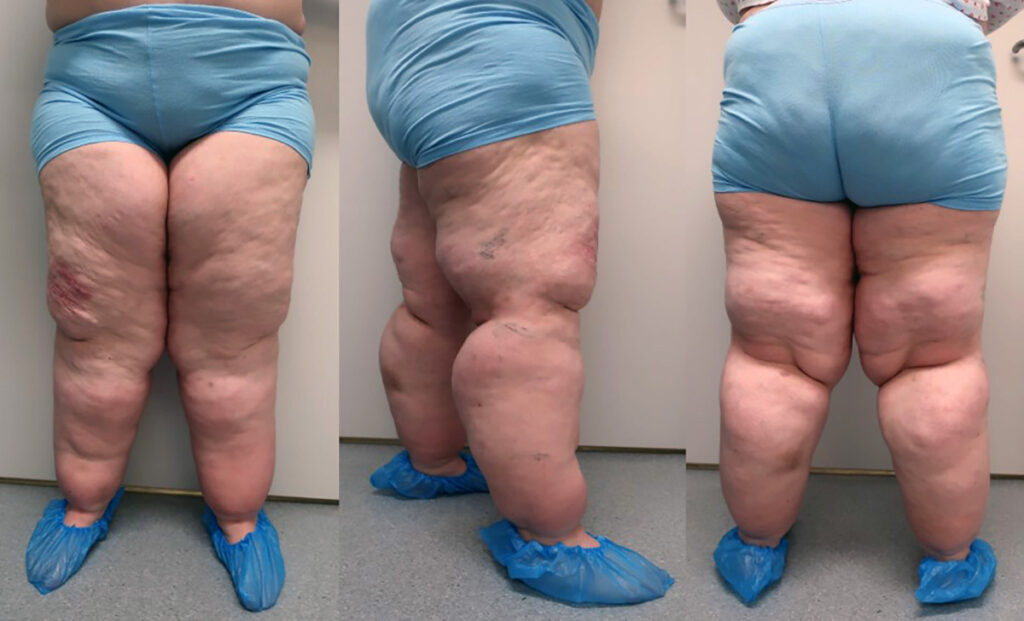 lipodem illustrasjon