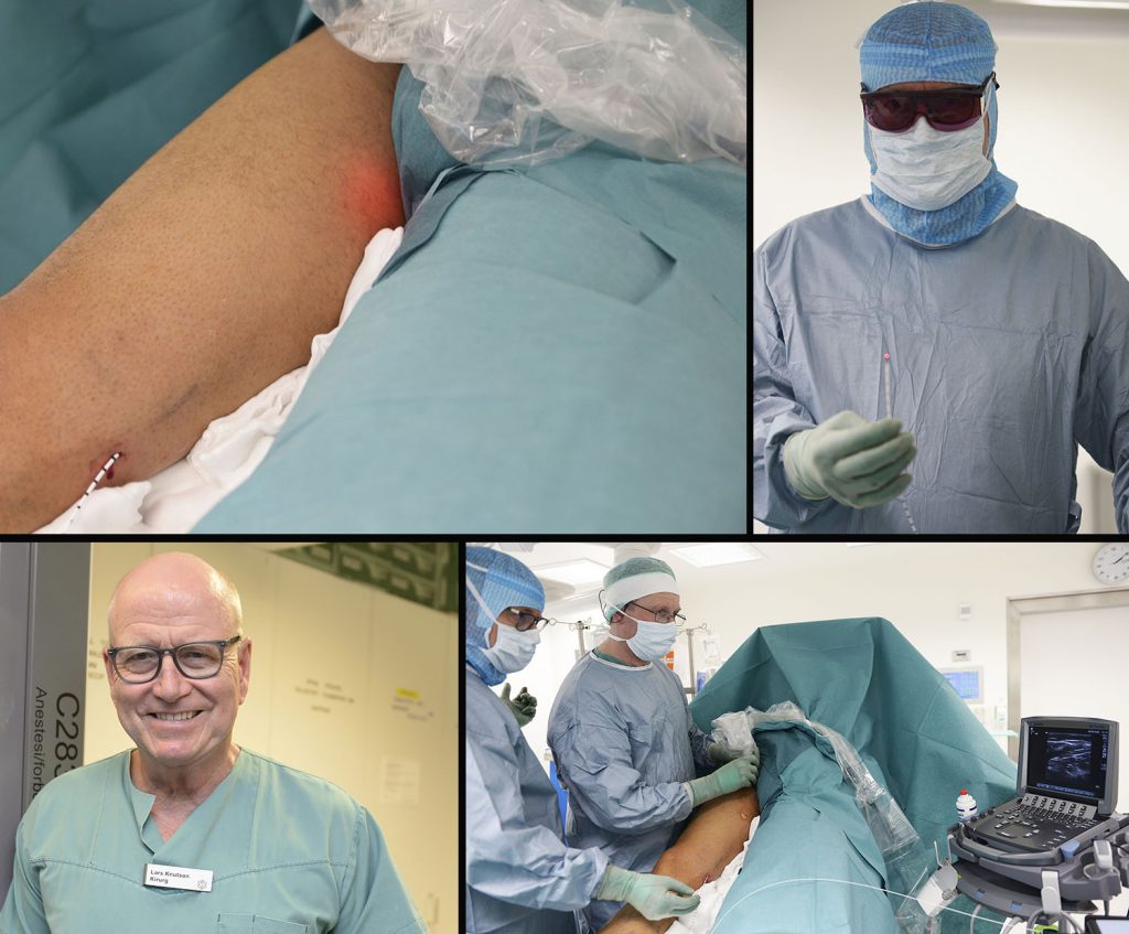 Kirurg Lars Knutson er nå i gang med laseroperasjoner med laser ved UNN i Narvik. Bildet oppe til venstre viser hvordan laseren er ført opp i et kateter fra kneet mot lysken, og lyser opp der selve "brenningen" skal gjennomføres. Laseren som benyttes er glødende het (oppe til høyre), og for å være sikker på at operasjonen blir vellykket sørger overlege og radiograf Jan Ole Frantzen for å bidra med hjelp av ultralyd (nede til høyre). Alle foto: Per-Christian Johansen