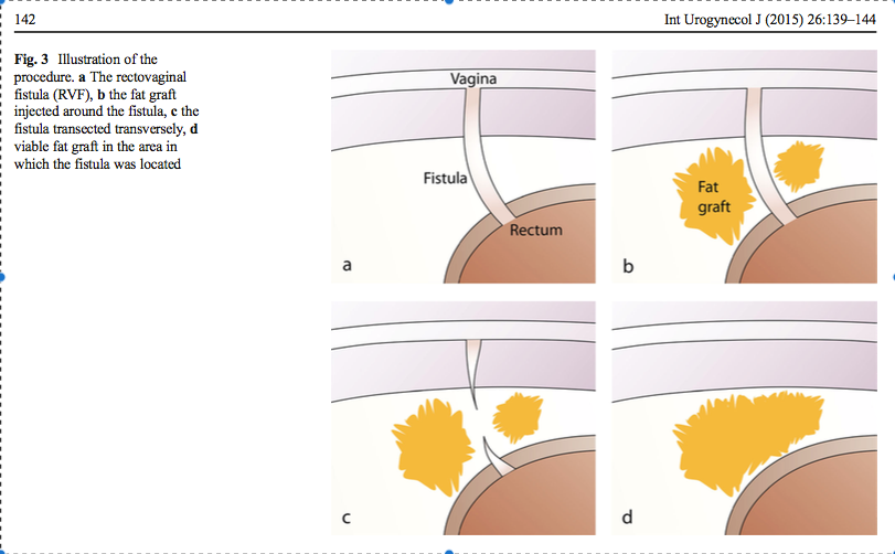 Her er en skisse over hvordan det gule fettvevet sprøytes inn i området rundt fistelen, gror sammen og fjerner den helt.