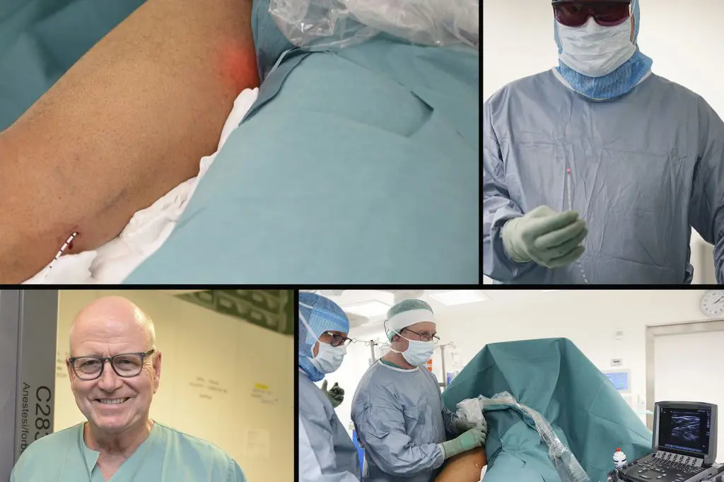 Kirurg Lars Knutson er nå i gang med laseroperasjoner med laser ved UNN i Narvik. Bildet oppe til venstre viser hvordan laseren er ført opp i et kateter fra kneet mot lysken, og lyser opp der selve "brenningen" skal gjennomføres. Laseren som benyttes er glødende het (oppe til høyre), og for å være sikker på at operasjonen blir vellykket sørger overlege og radiograf Jan Ole Frantzen for å bidra med hjelp av ultralyd (nede til høyre). Alle foto: Per-Christian Johansen