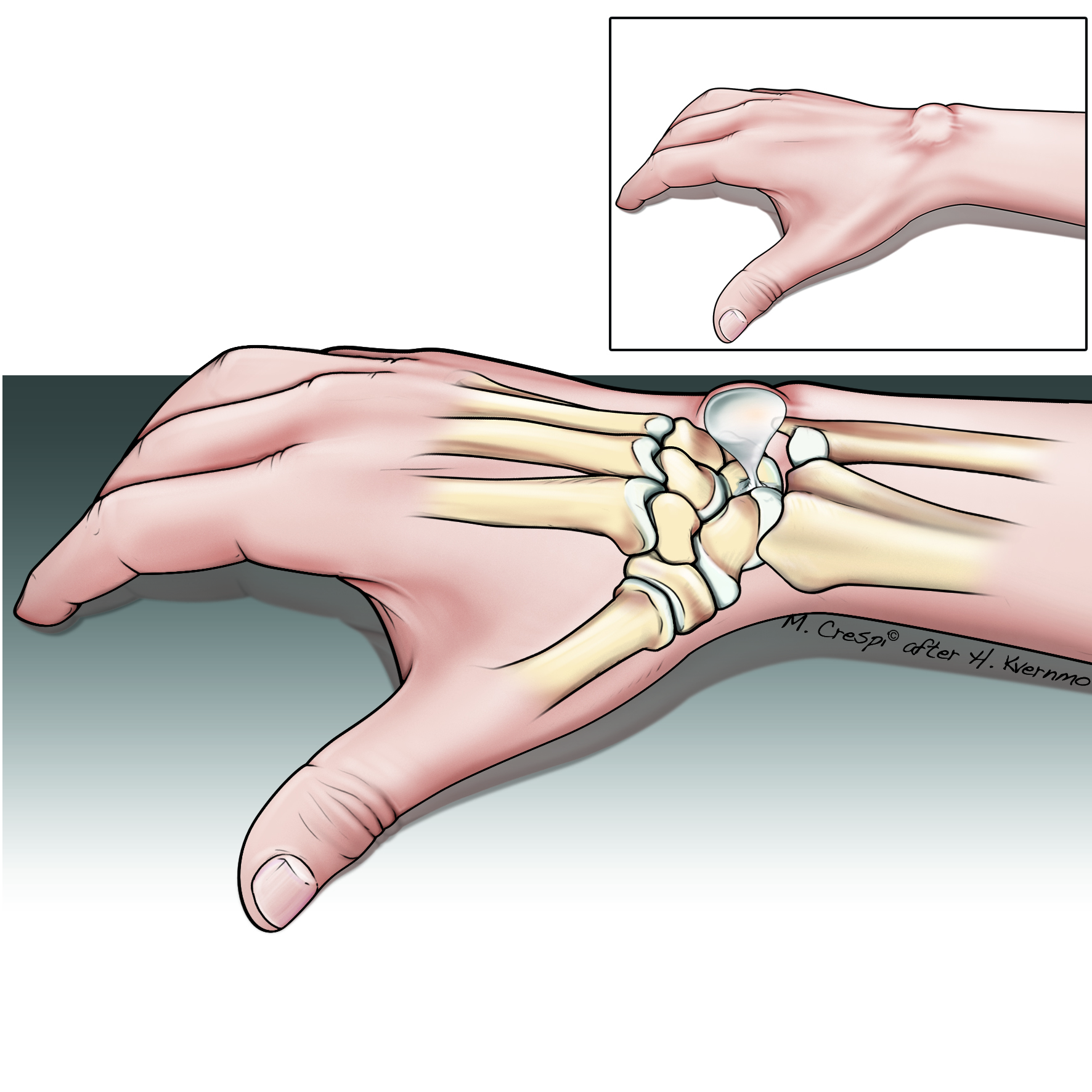 Ganglion på håndryggen