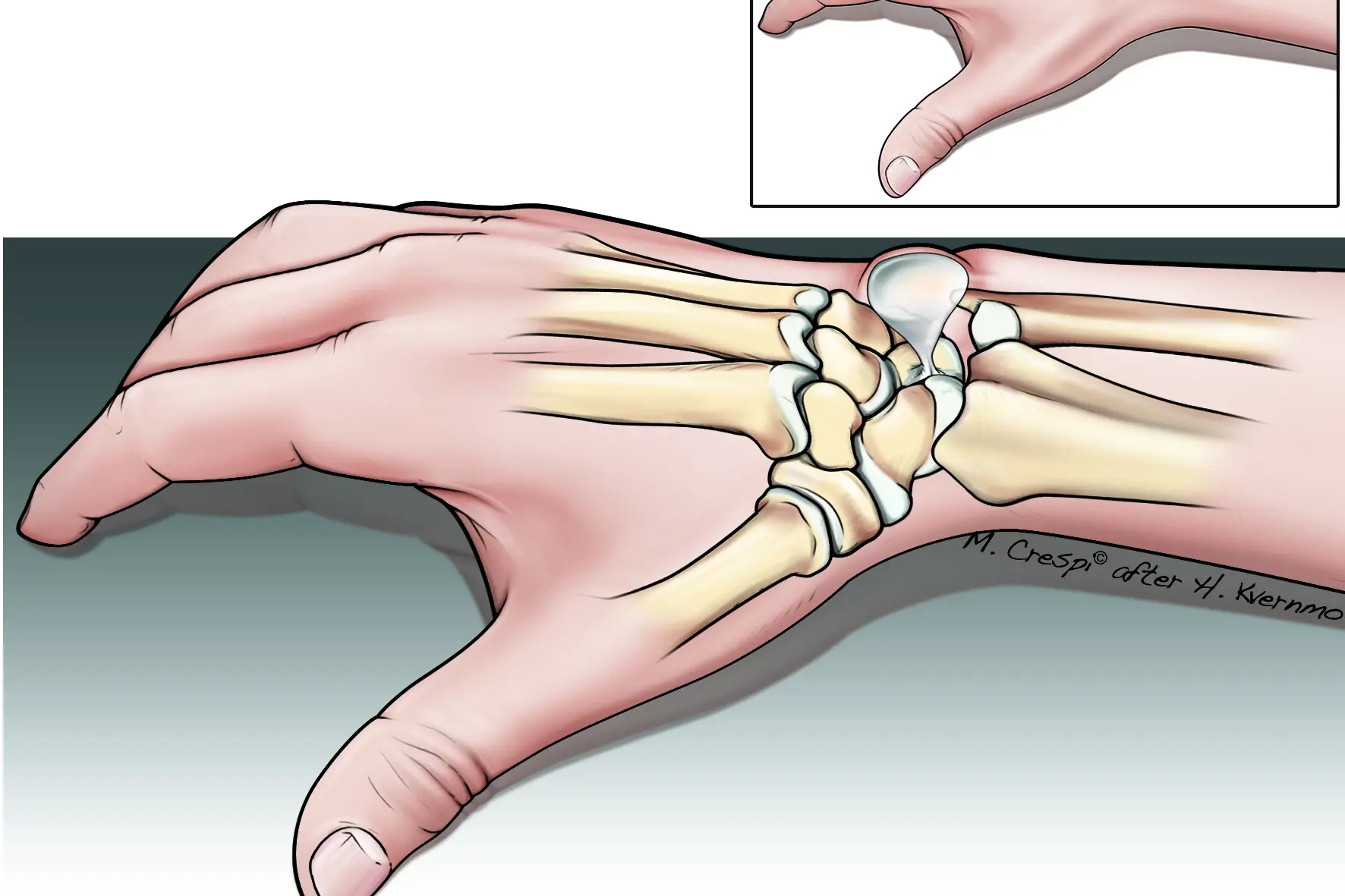 Ganglion på håndryggen