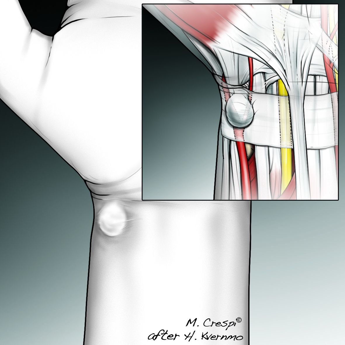 Ganglion på håndflatesiden