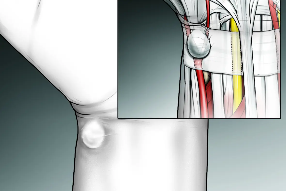 Ganglion på håndflatesiden