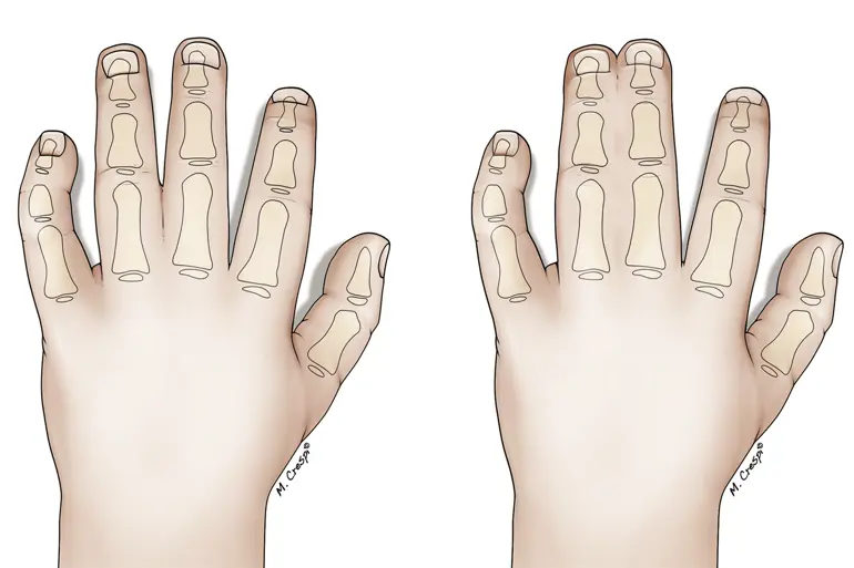 Enkel syndactyli