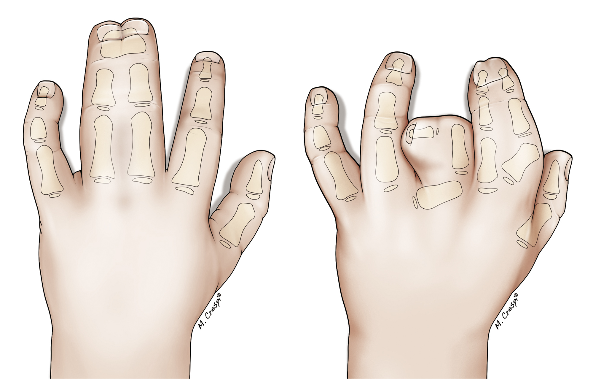 Kompleks syndactyli