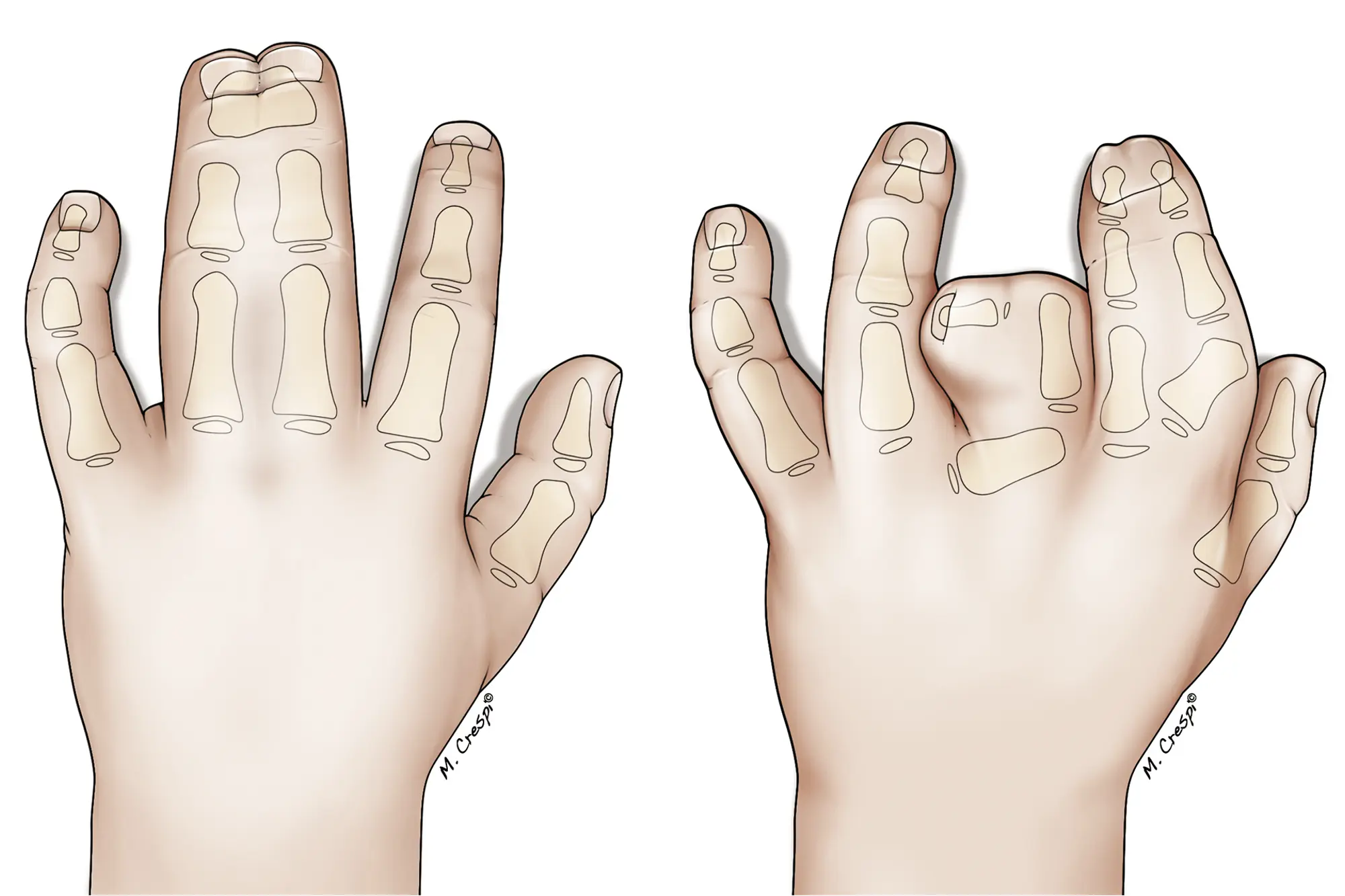 Kompleks syndactyli