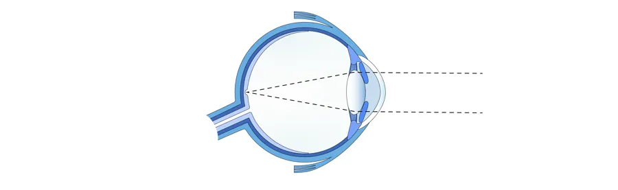Illustrasjon av øyeeple som med streker vises hvordan normalt syn fungerer.