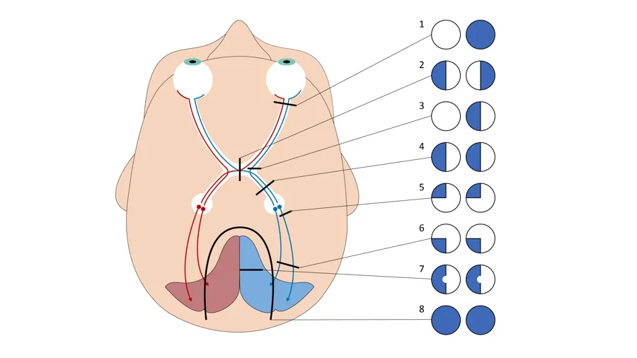 Illustrasjon av et hode som viser synsfeltutfall på grunn av skader i synsbanene. Bildet viser også hvit rundinger med forskjellige grader av blått i seg.