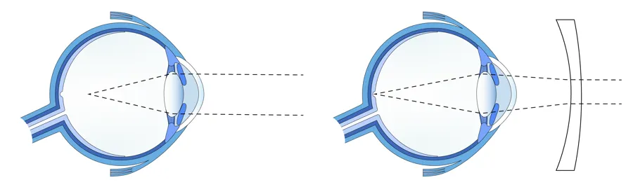 To illustrasjoner av øyeeple der den venstre illustrerer nærsynthet og den høyre illustrerer normalt syn ved bruk av linse.