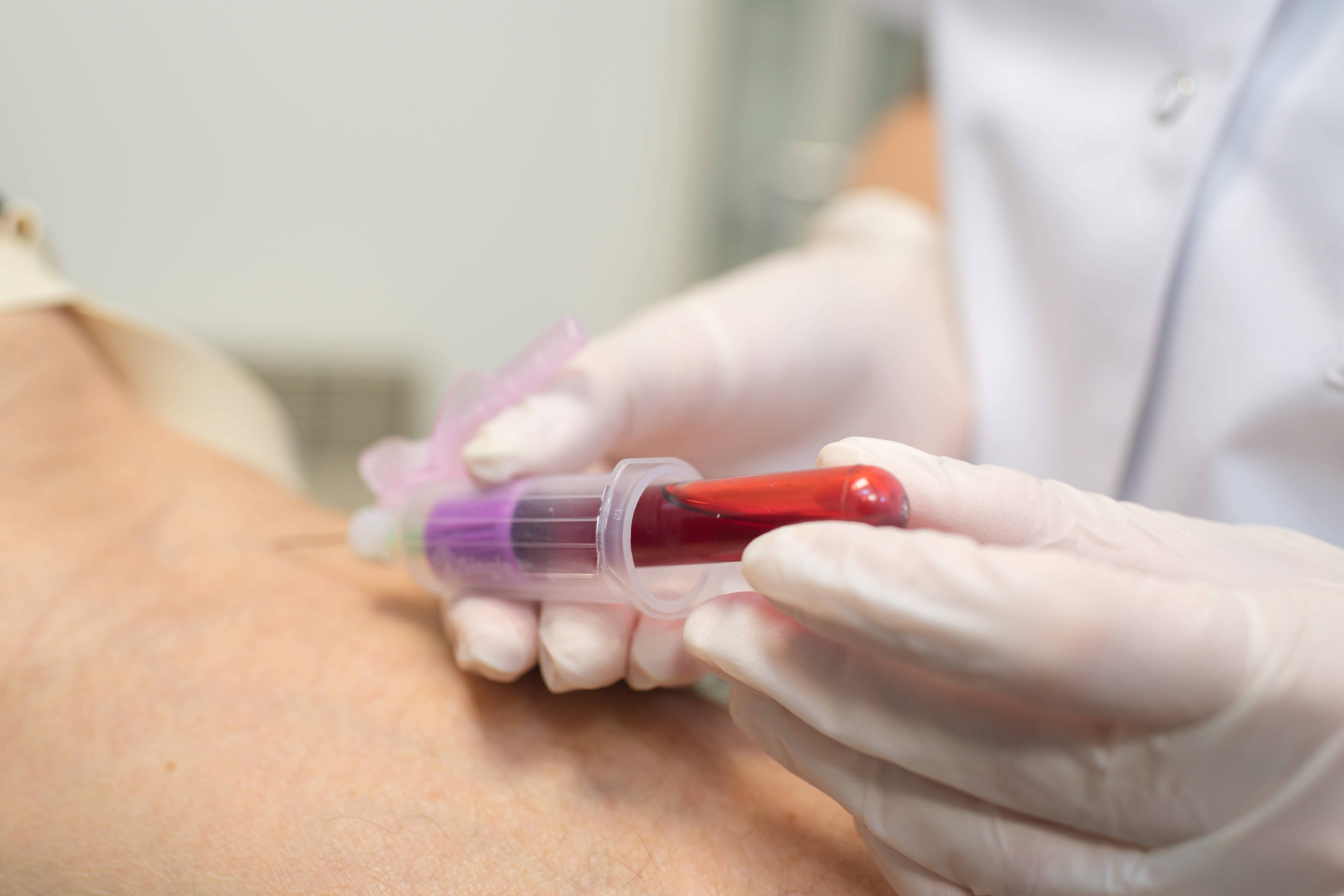 Hender med hansker tar blodprøve fra en arm.